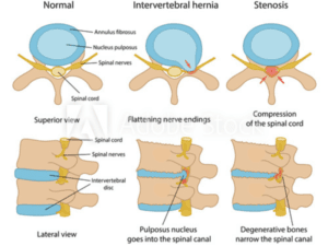 LUMBAR CANAL STENOSISSpinal stenosis is a narrowing of the spinal canal, which places pressure on the spinal cord. If the stenosis is located on the lower part